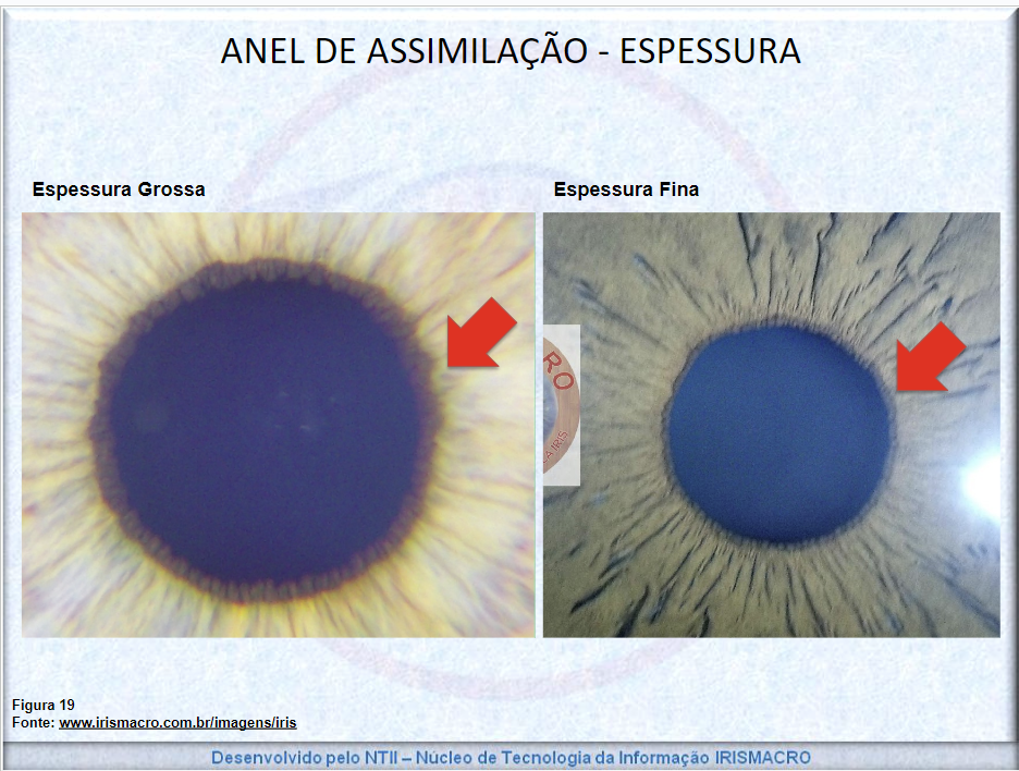 Irismacro iridologia - Anel de assimilação - orla pupilar interna - opi